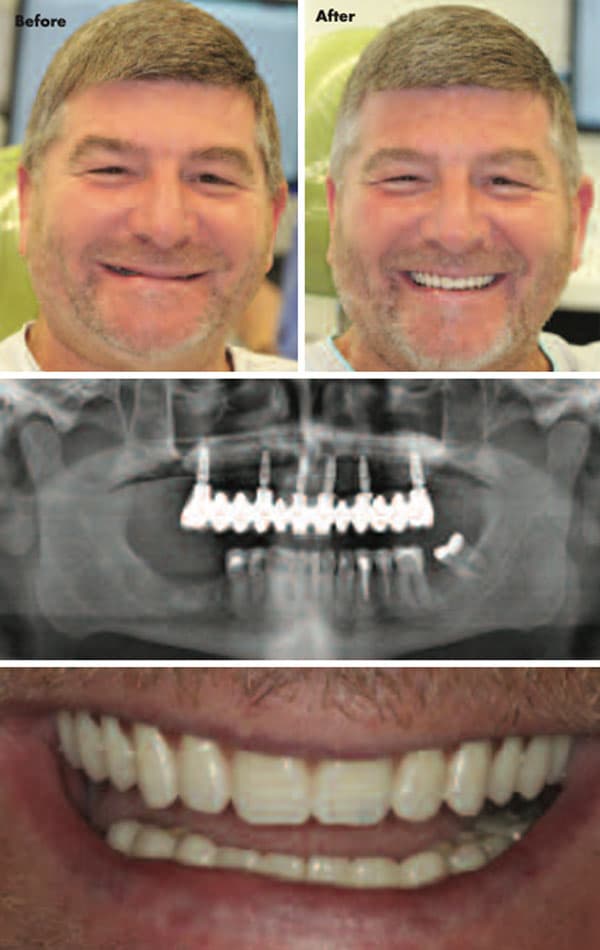 Dental Implants Case Study 2