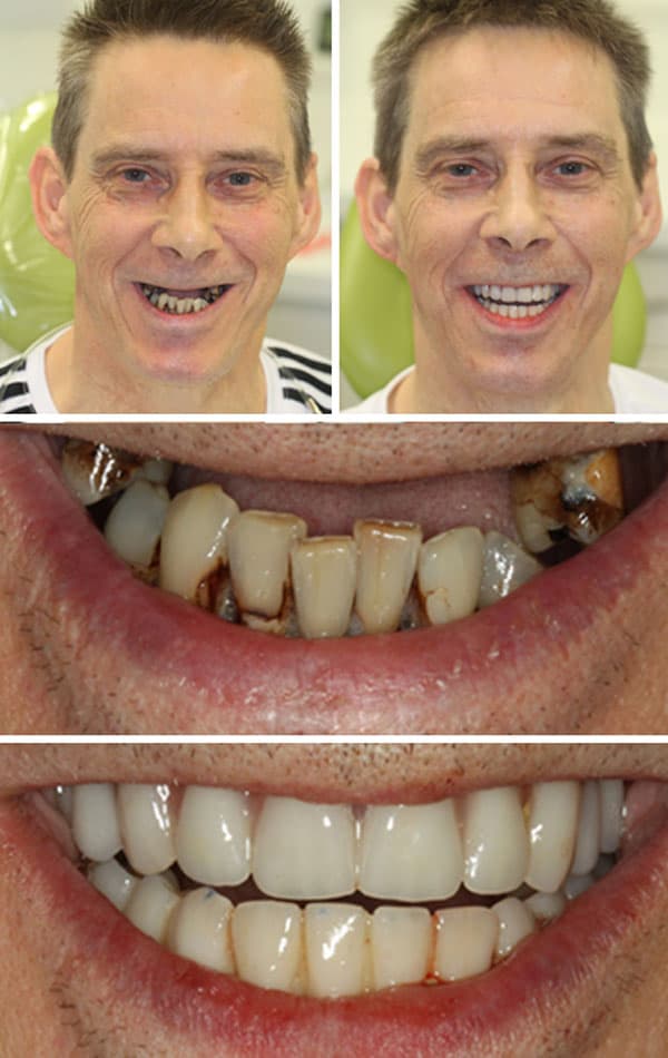 Dental Implants Case Study 3