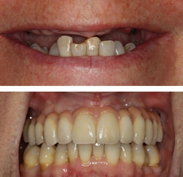 Dental Implants Case Study 5