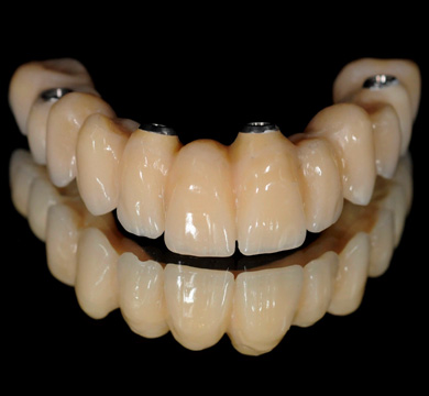 Teeth-in-a-Day-case-12
