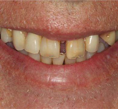 Teeth-in-a-Day-case-2