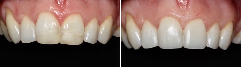 Composite Bonding Before After