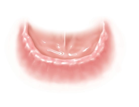 Implant-Retained-Dentures-1