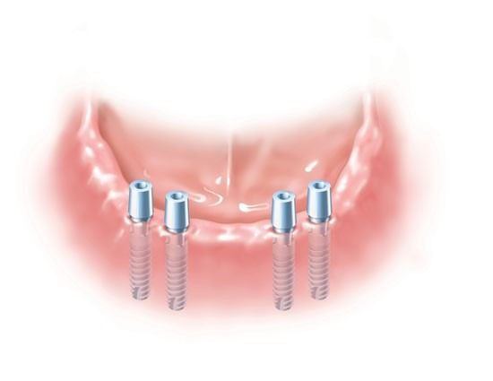Implant-Retained-Dentures-2