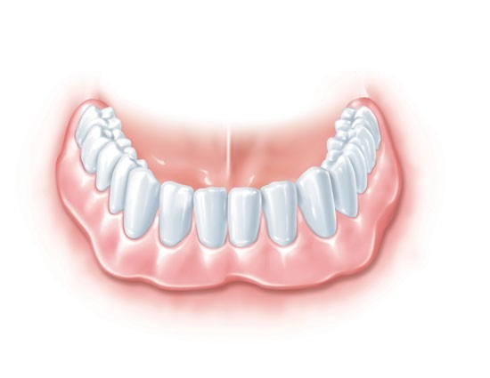 Implant-Retained-Dentures-4