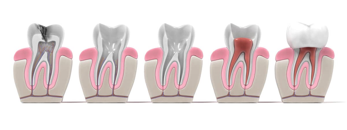 Root Canal Treatment Procedure Staines